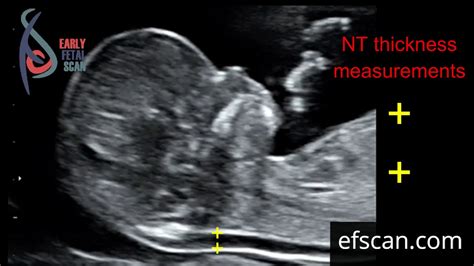 nuchal fold thickness measurement at 14 weeks|nuchal fold thickness normal range.